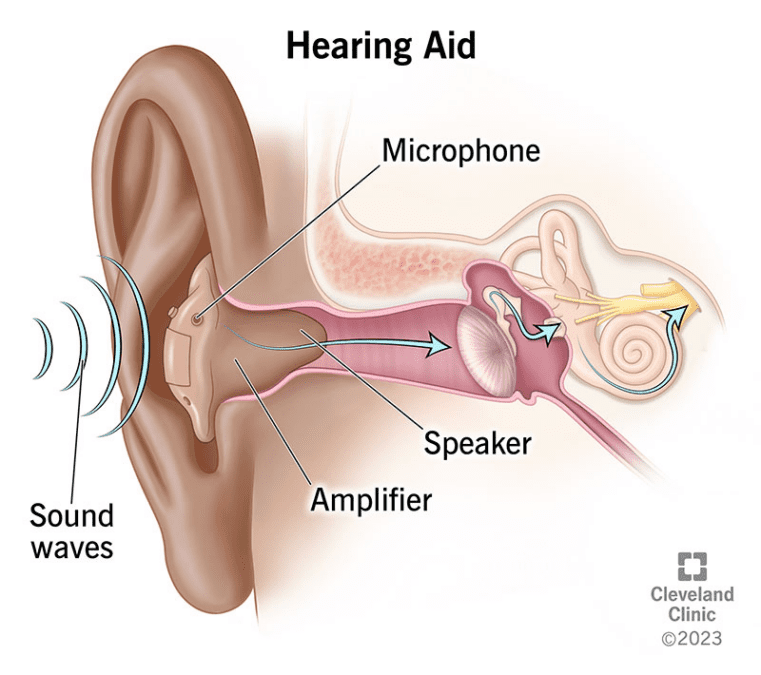 The Crucial Role of Hearing Aids: