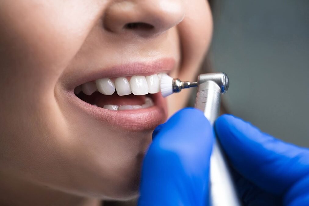 Teeth Cleaning and Polishing Benefits